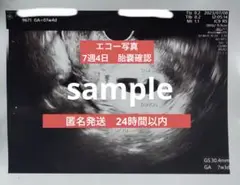 妊娠エコー写真
