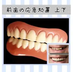 歯の応急処置 前歯のカバー