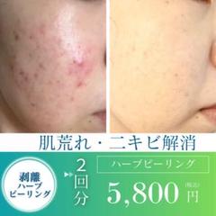 【新年セール】剥離ありハーブピーリング20回分 大特価セール】剥離ありハーブピーリング20回分