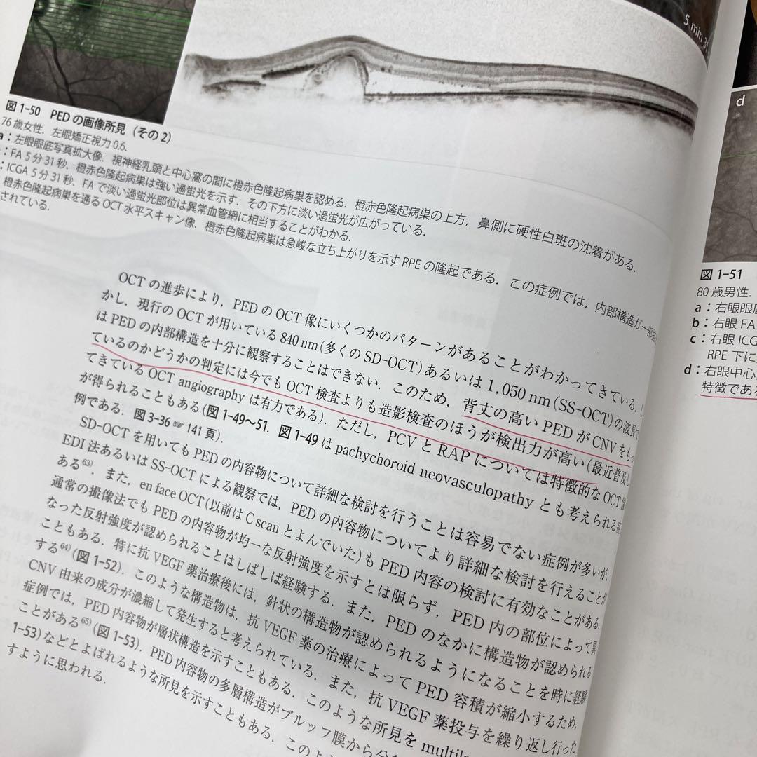 加齢黄斑変性