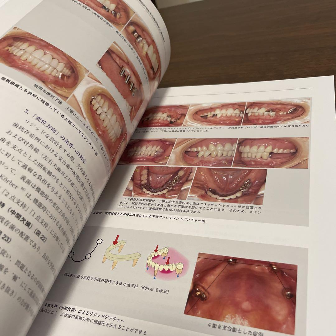 長期経過症例から導く欠損補綴設計のフォーカスポイント - 健康・医学 長期経過症例から導く欠損補綴設計のフォーカスポイント - 健康・医学