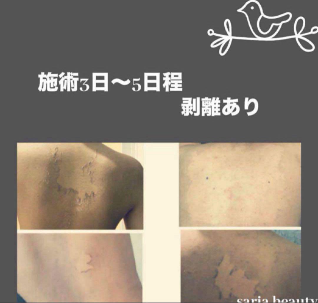 ハーブピーリング　剥離あり　業務用　CICA アロエベラ　ツボクサ　オーガニック