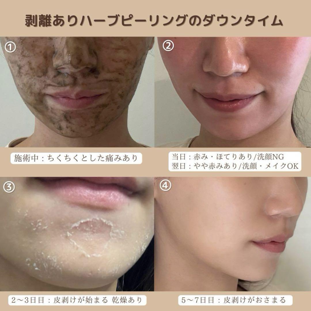剥離ありハーブピーリング2回分