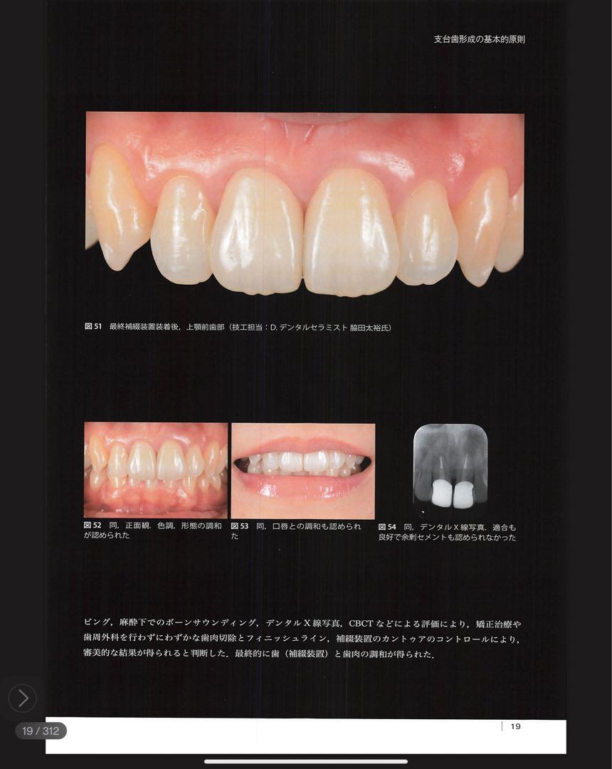 The Tooth Preparation : 補綴修復治療の成功を目指した支…岩田淳