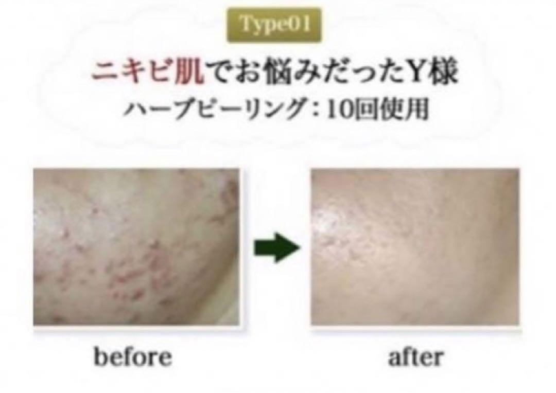 ハーブピーリング 剥離なし 10回分(10g)業務用 美容液