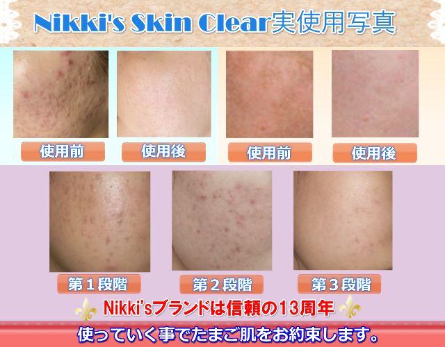 しみ、そばかす、ニキビ跡、毛穴　噂のNikki's Skin Clear　通常版 ニッキーズスキンクリア Nikki's Skin Clear 通常使用 (シミ