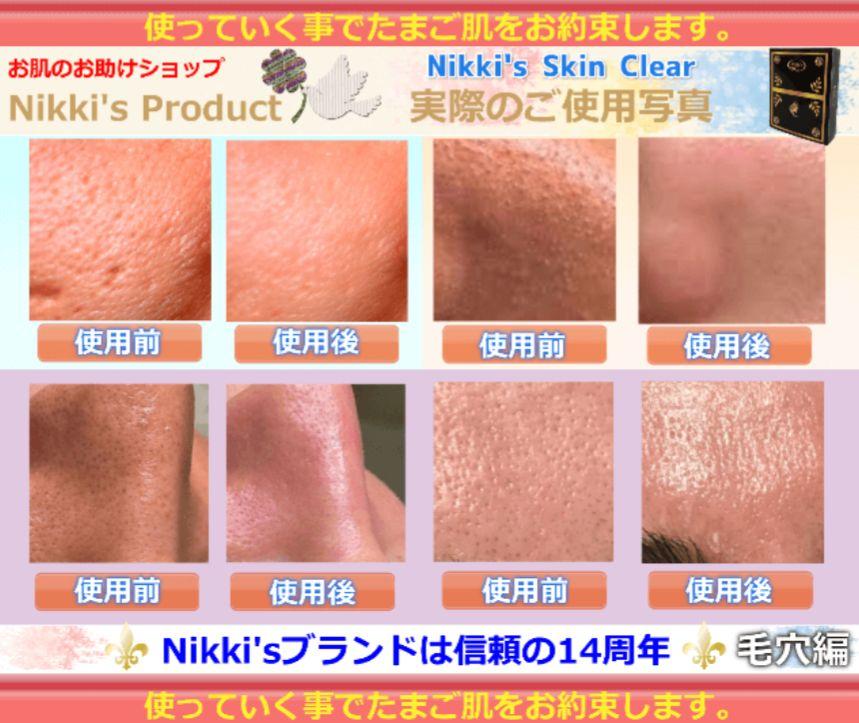 ニキビ跡、毛穴、しみ、そばかす　噂のNikki's Skin Clear 通常版 しみ、そばかす、ニキビ跡、毛穴 噂のNikki's Skin Clear 通常版
