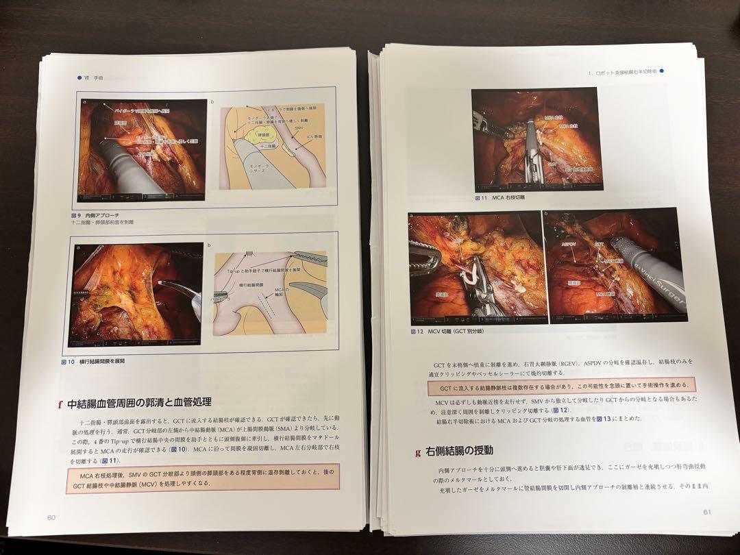 絹笠式TMDU大腸癌手術[Web動画付]