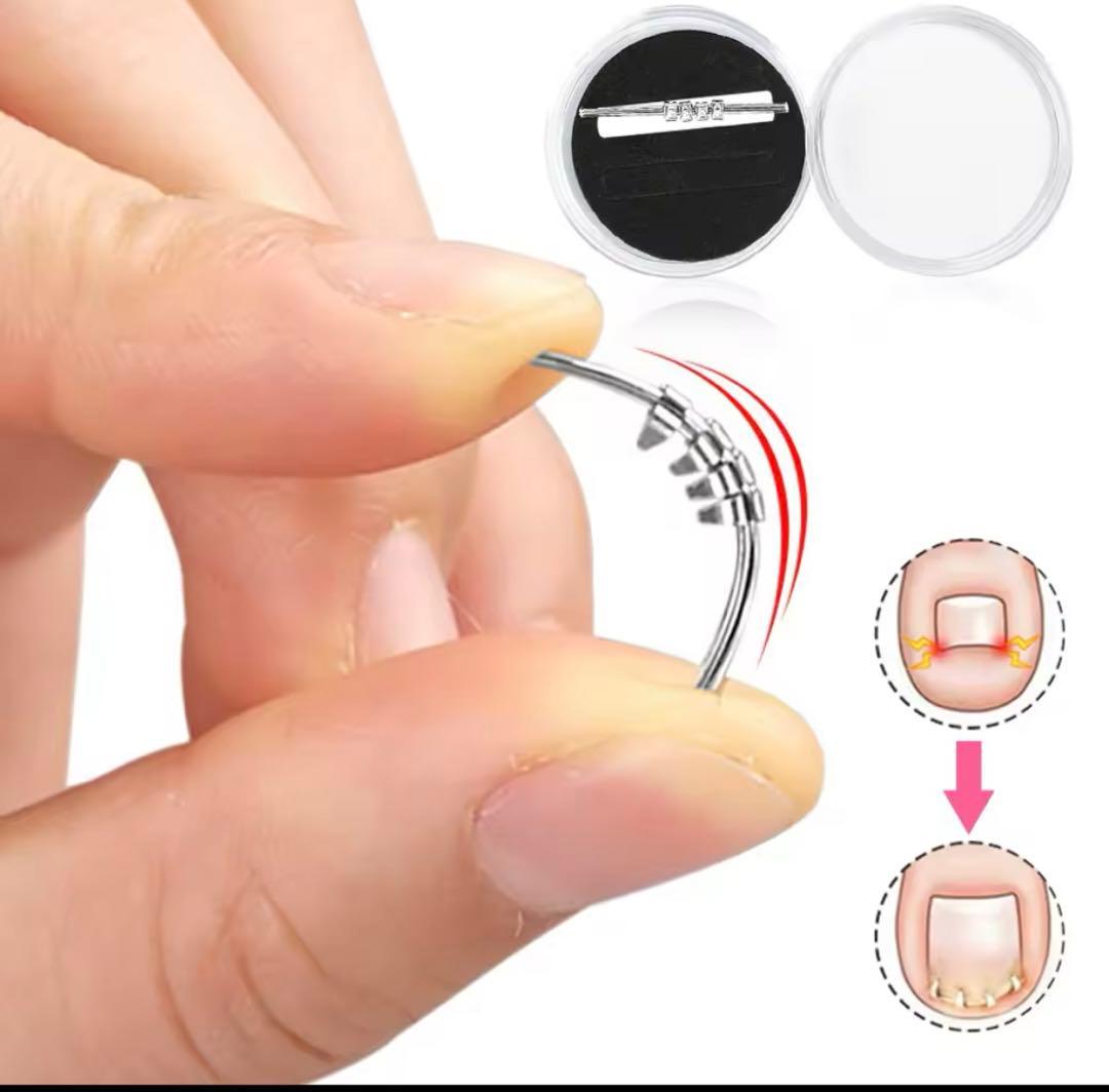 巻き爪 ケア 陥入爪 クリップ リフト 4個セット - メルカリ