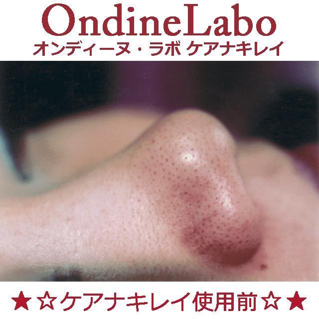 ★☆毛穴の汚れ＆角栓＆吸引器専用☆★ケアナキレイ＆スキンアップローションセット