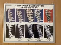 サブラクセーション パネル入 カイロプラクティック - メルカリ