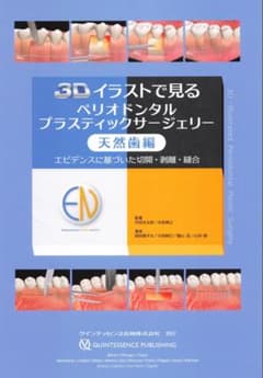 天然歯編　3Dイラストで見るペリオドンタルプラスティックサージェリーのサムネイル