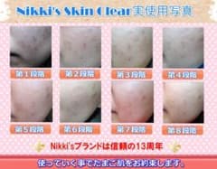 ニキビ跡、毛穴、しみ、そばかす 噂のNikki's Skin Clear 通常版