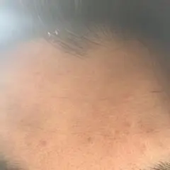 センター分けニキビ