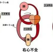 頸静脈怒張の画像